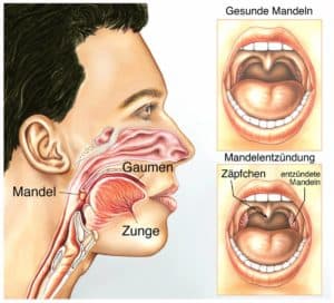 Mandelentzündung homöopathisch behandeln