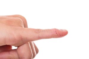 Störung der Nägel homöopathisch behandeln