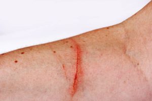 Hautverletzungen mit Hausmitteln behandeln